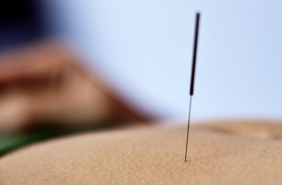 acupuncture-needle