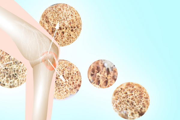 What Is Osteoporosis? What Causes It, Symptoms & More