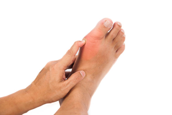 Gout – Causes, Symptoms and Treatments